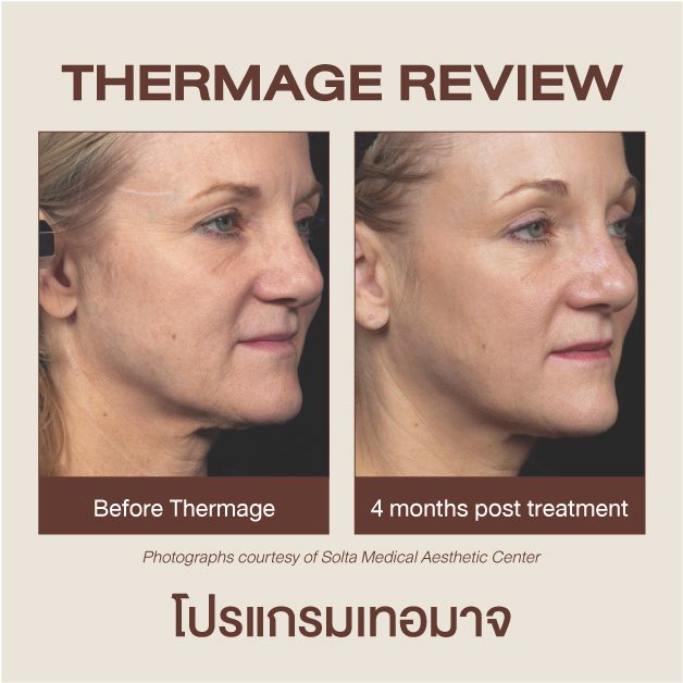 รีวิว Ulthera