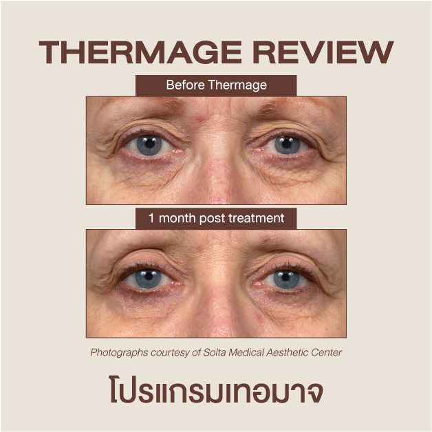 รีวิว Thermage