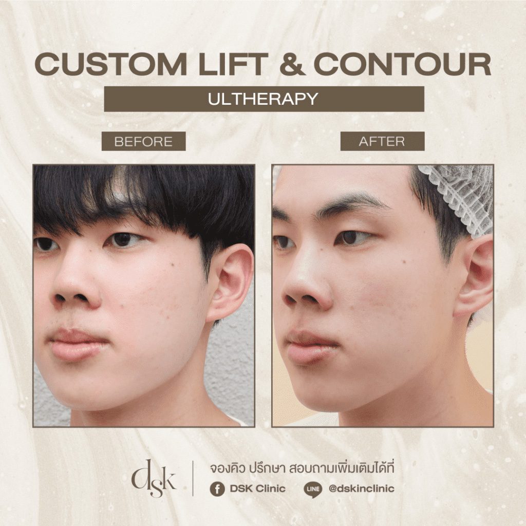 รีวิว Ulthera กับ Thermage