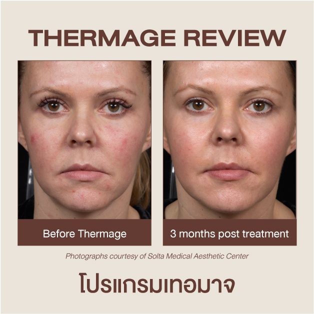 รีวิว Ulthera กับ Thermage ที่ DSK Clinic