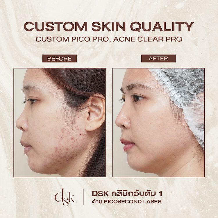 รีวิวการรักษารอยแผลเป็นจากสิว