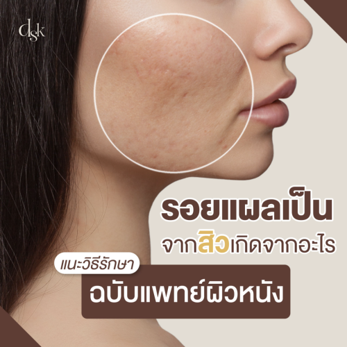 รอยแผลเป็นจากสิวเกิดจากอะไร แนะวิธีรักษา ฉบับแพทย์ผิวหนัง
