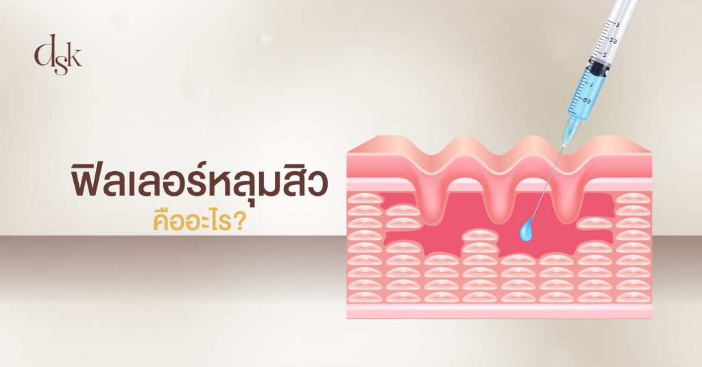ฟิลเลอร์หลุมสิว คืออะไร?