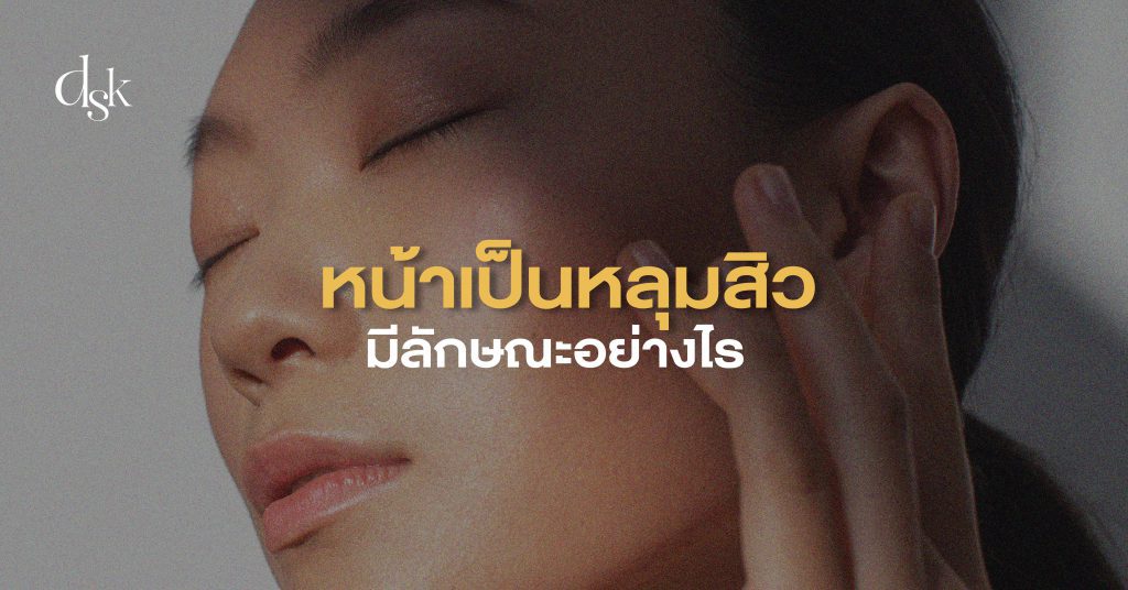 หน้าเป็นหลุมสิว มีลักษณะอย่างไร