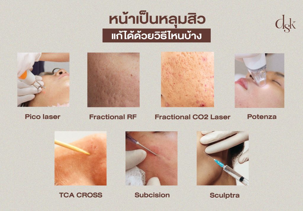 หน้าเป็นหลุมสิว แก้ได้ด้วยวิธีไหนบ้าง