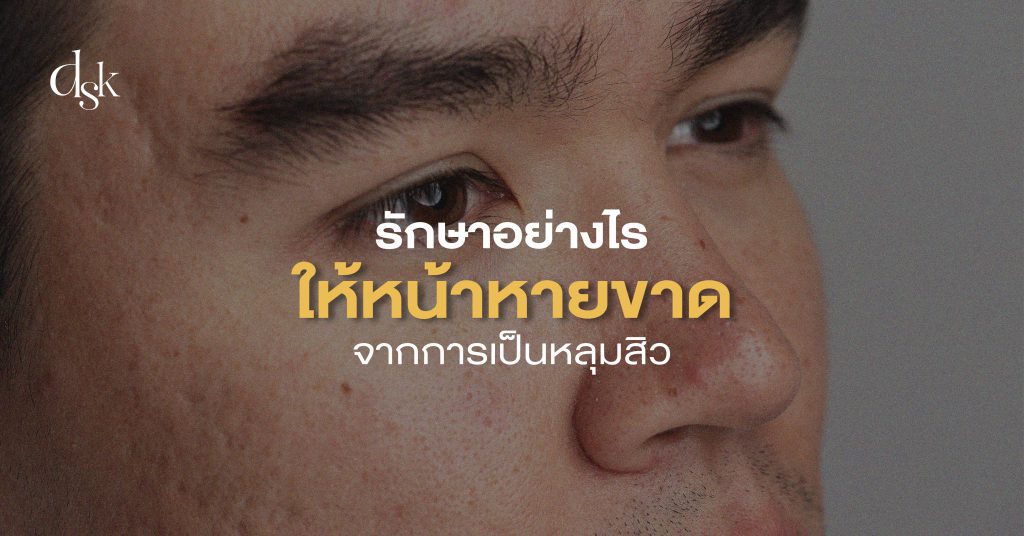 รักษาอย่างไรให้หน้าหายขาดจากการเป็นหลุมสิว