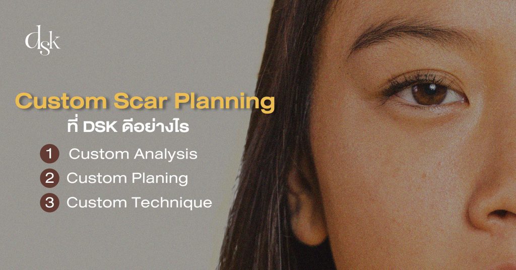 Custom Scar Planning ที่ DSK ดีอย่างไร