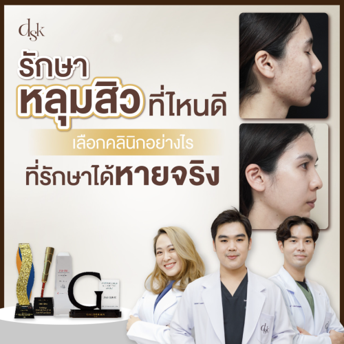 รักษาหลุมสิวที่ไหนดี  เลือกคลินิกอย่างไร ที่รักษาได้หายจริง