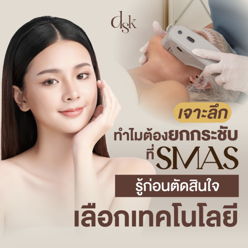 เจาะลึก ทำไมต้องยกกระชับที่ SMAS รู้ก่อนตัดสินใจเลือกเทคโนโลยี