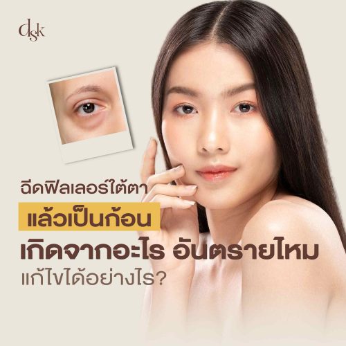ฉีดฟิลเลอร์ใต้ตาแล้วเป็นก้อนเกิดอะไร อันตรายไหม แก้ไขได้อย่างไร?