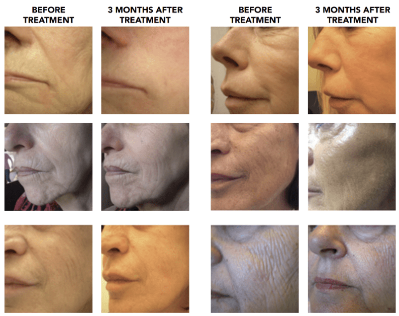 รีวิว Profhilo