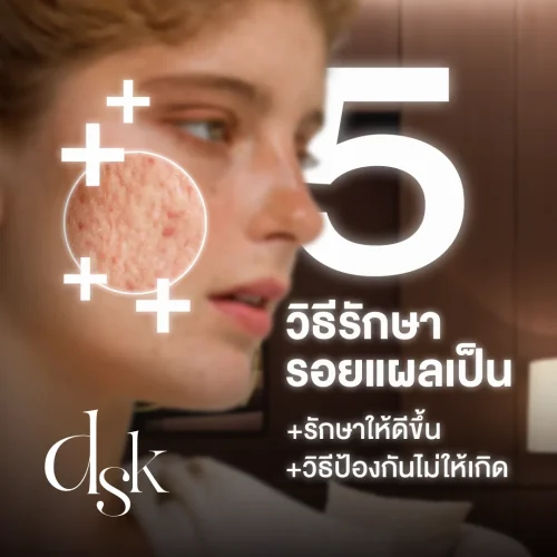 5 วิธีรักษารอยแผลเป็นให้ดีขึ้น พร้อมวิธีป้องกันไม่ให้เกิดแผลเป็น