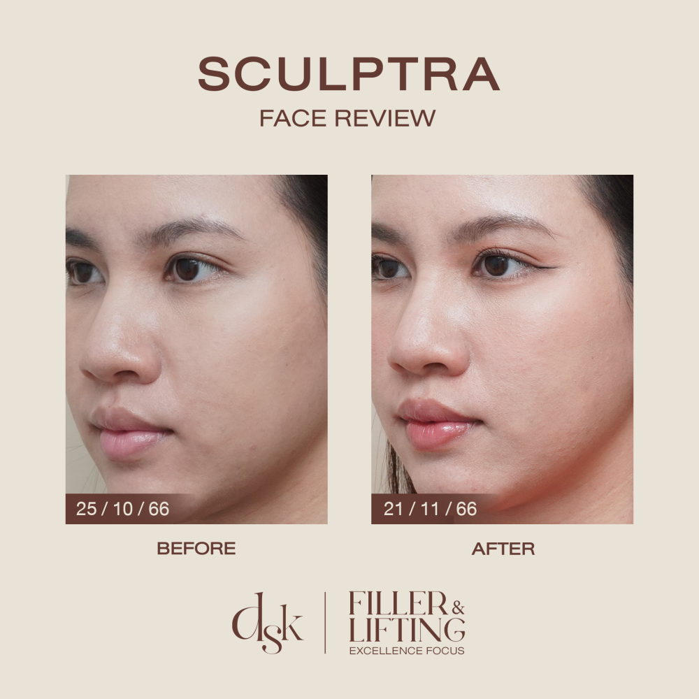 HN.B66-000717_Sculptra