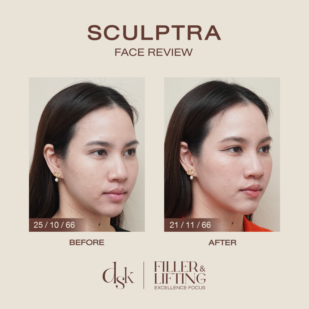 HN.B66-000717_Sculptra (side)