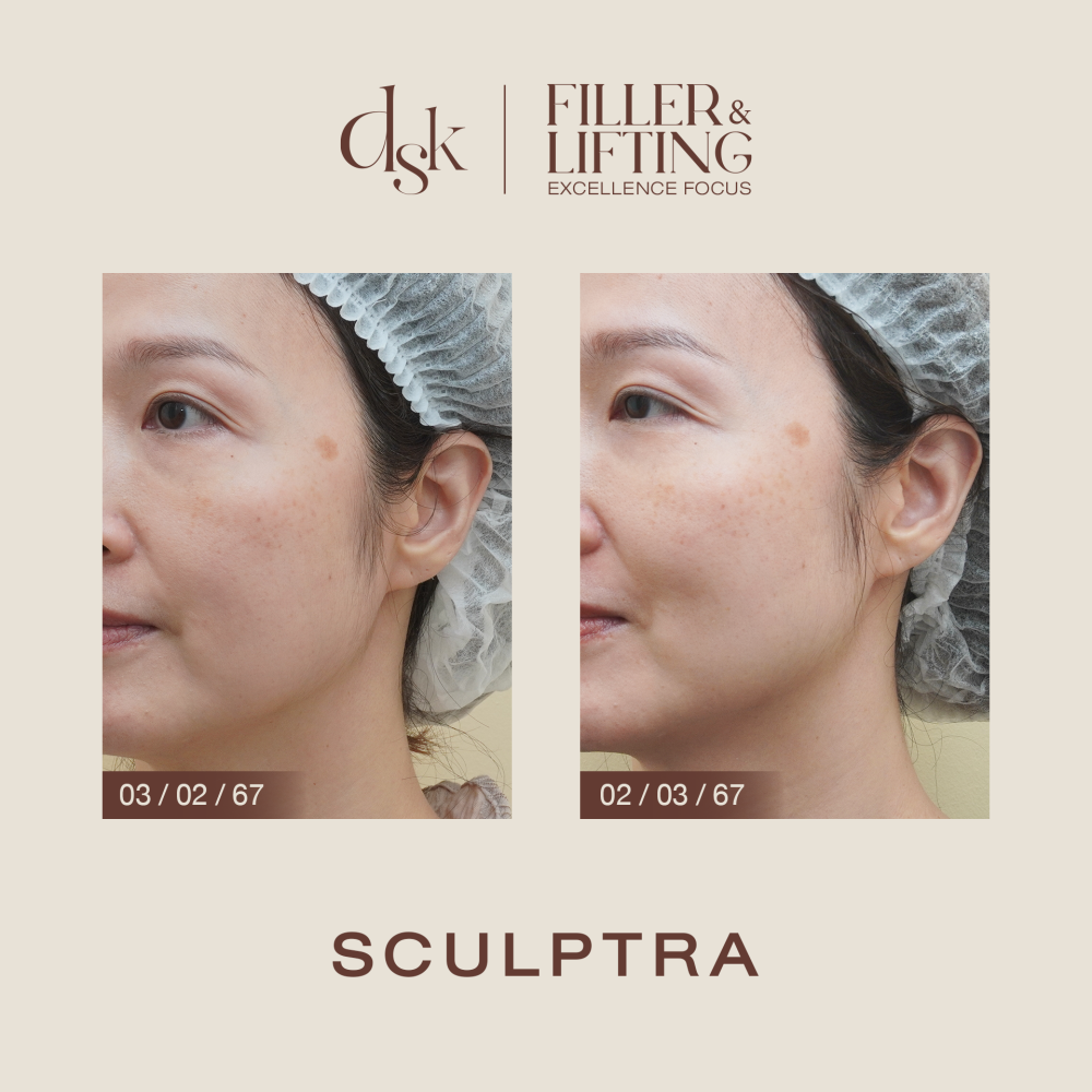 HN.B67-000991_Sculptra