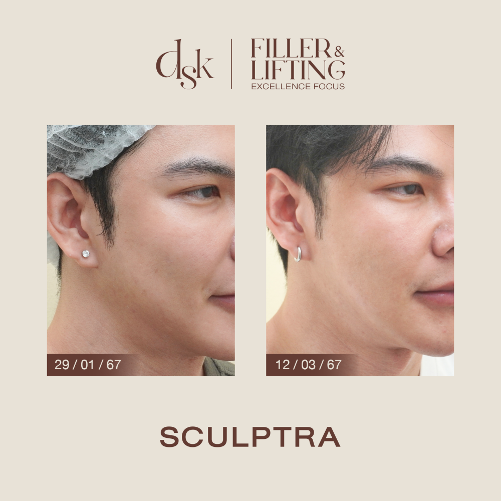 HN.B67-000996_Sculptra