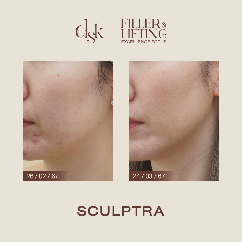 HN.B67-001043_Sculptra