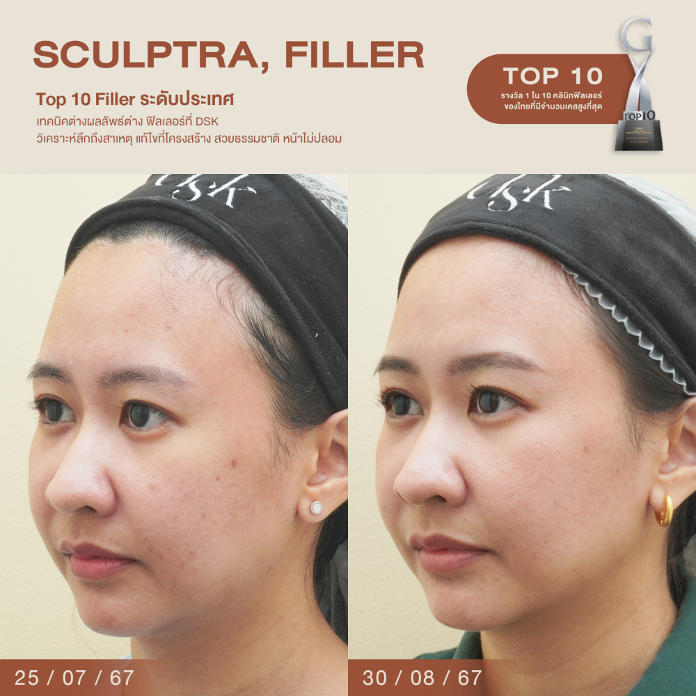 HN.B67-001319_Sculptra,filler_dr.sai