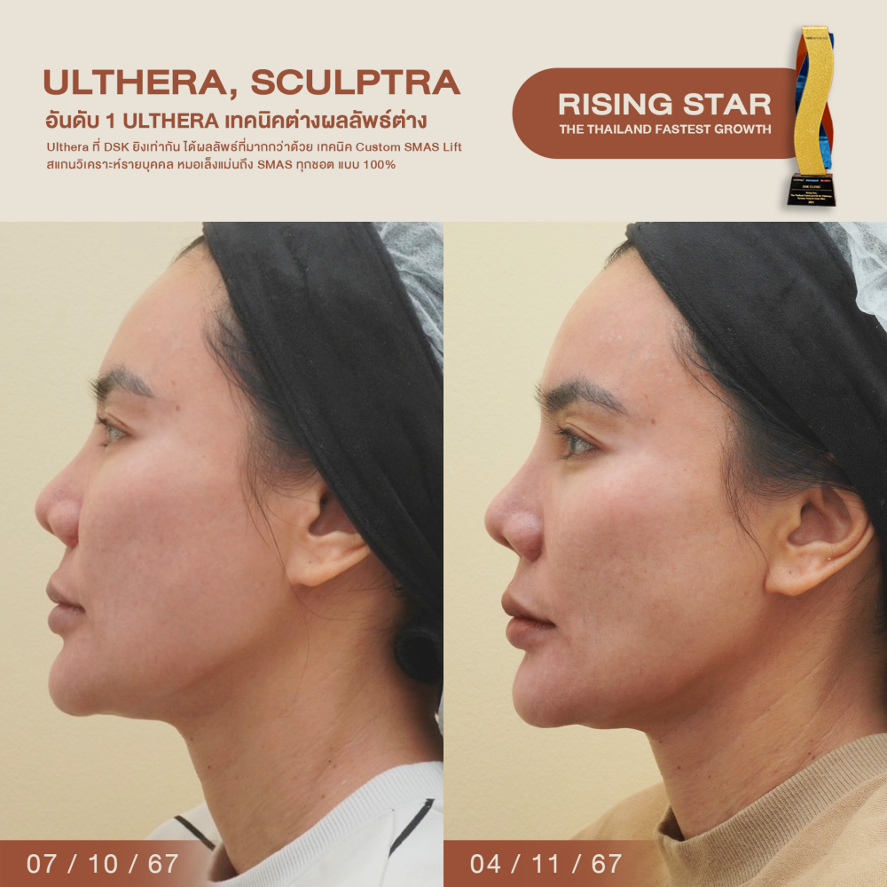 HN.B67-001460_ulthera_dr.gift