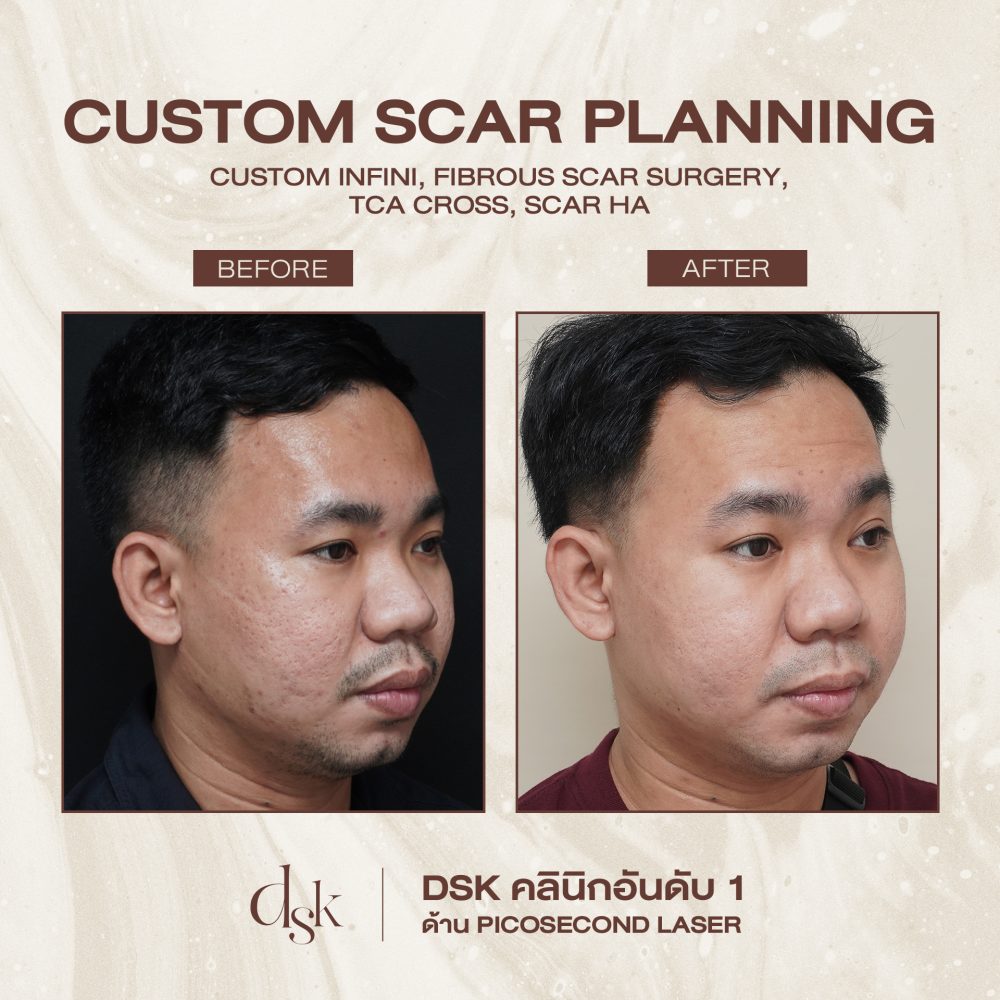 HN.R64-000009_CUSTOM SCAR (side)