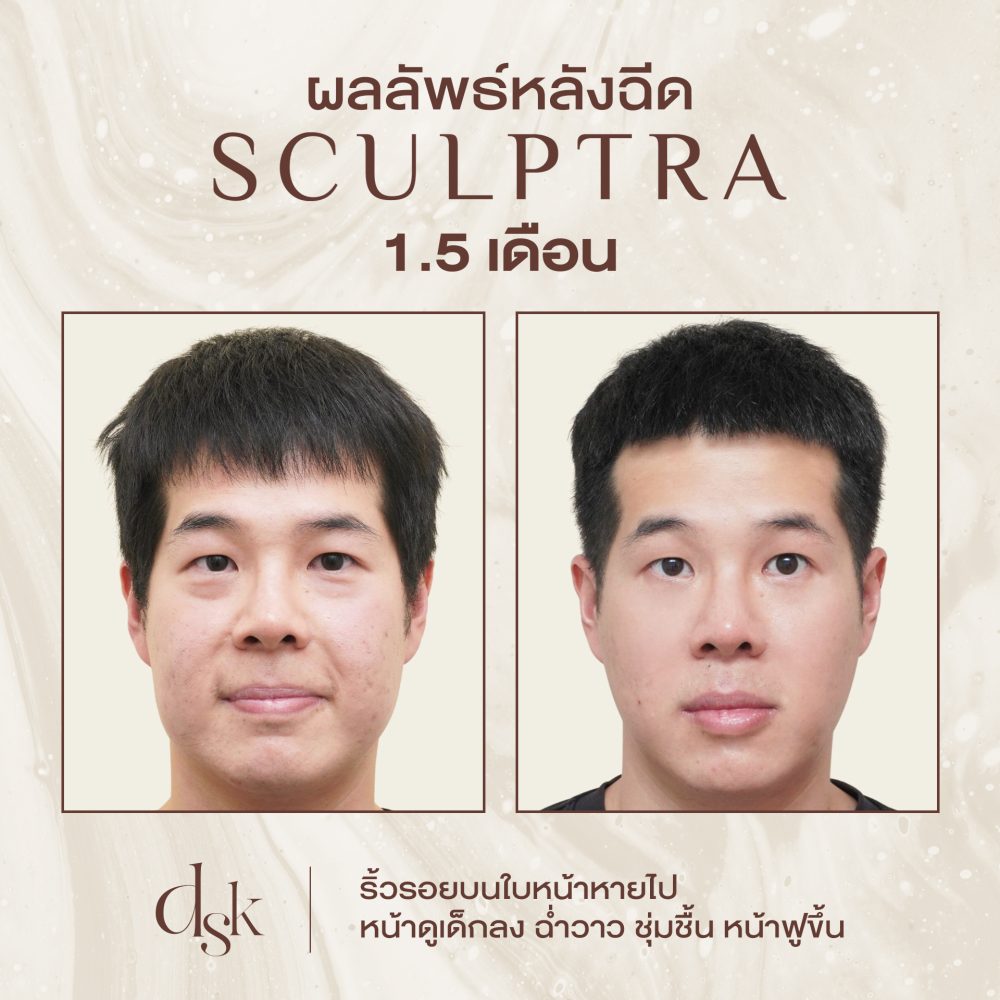 HN.R65-015689_Sculptra