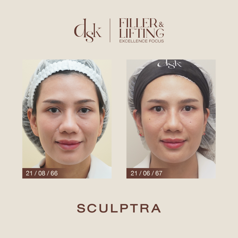 HN.R65-015851_Sculptra_