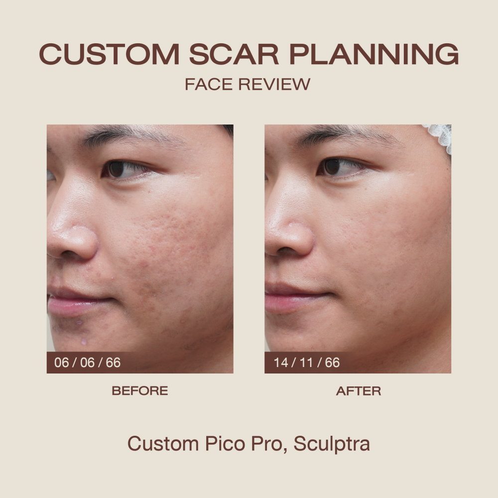 HN.R65-017058_ Custom Scar planing side