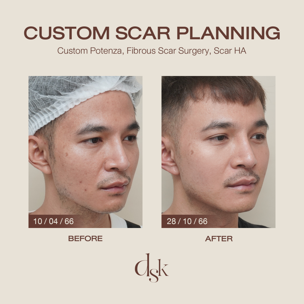 HN.R66-017911_Custom Scar planing