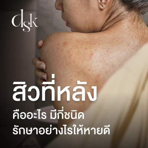 ไขทุกข้อสงสัย สิวที่หลังคืออะไร มีกี่ชนิด รักษาอย่างไรให้หายดี