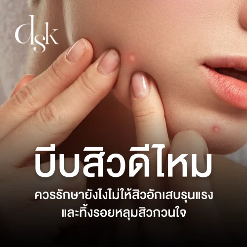บีบสิวดีไหม ควรรักษายังไงไม่ให้สิวอักเสบรุนแรงและทิ้งรอยหลุมสิวกวนใจ