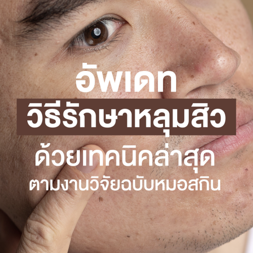 อัพเดท 2025 รักษาหลุมสิว ด้วยเทคนิคล่าสุด ตามงานวิจัยฉบับหมอสกิน