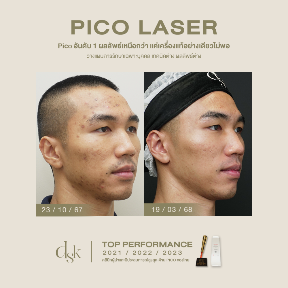 HN.A67-000356_Custom Pico Pro, Acne Clear Pro