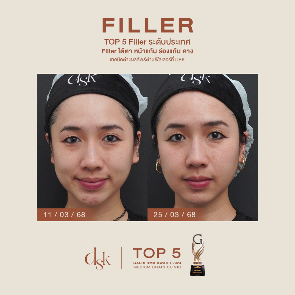 HN.B66-000450 _filler ใต้ตาหน้าแก้มร่องแก้มคาง_dr.prince