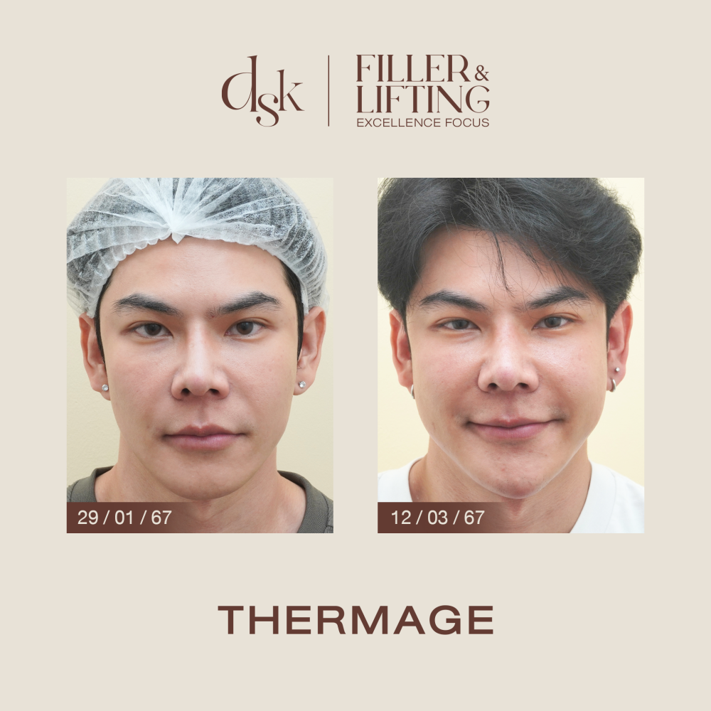 HN.B67-000996_Thermage_dr.prince