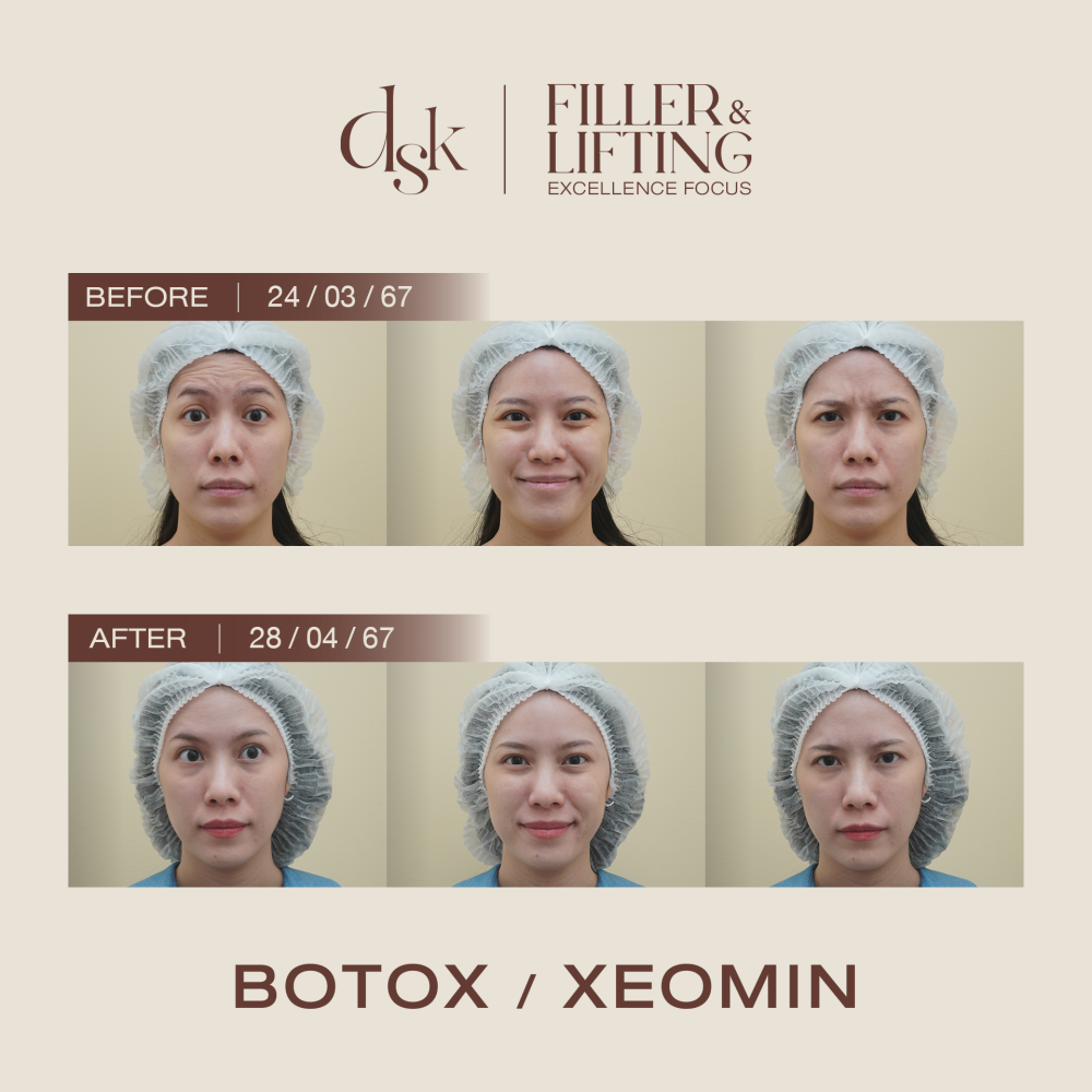 HN.B67-001109_botox_