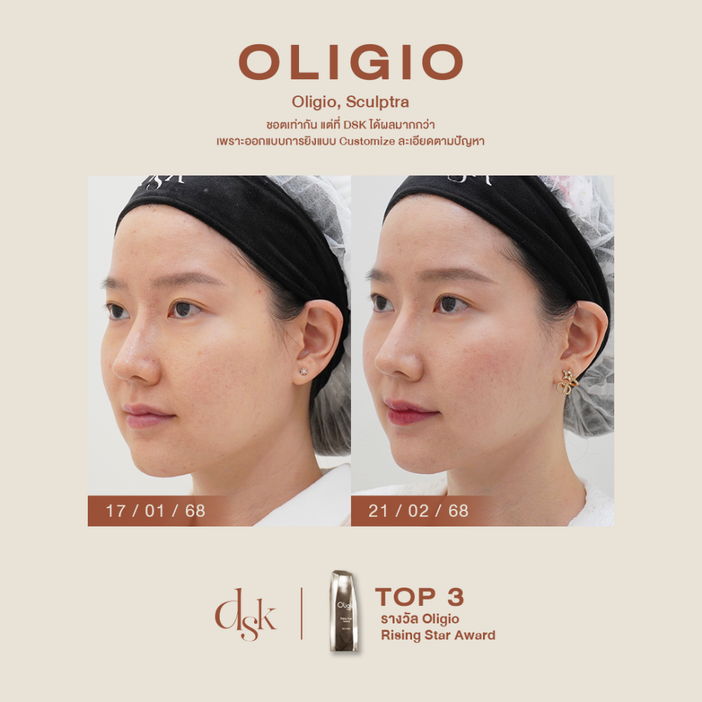 HN.P67-000292_Oligio,sculptra_