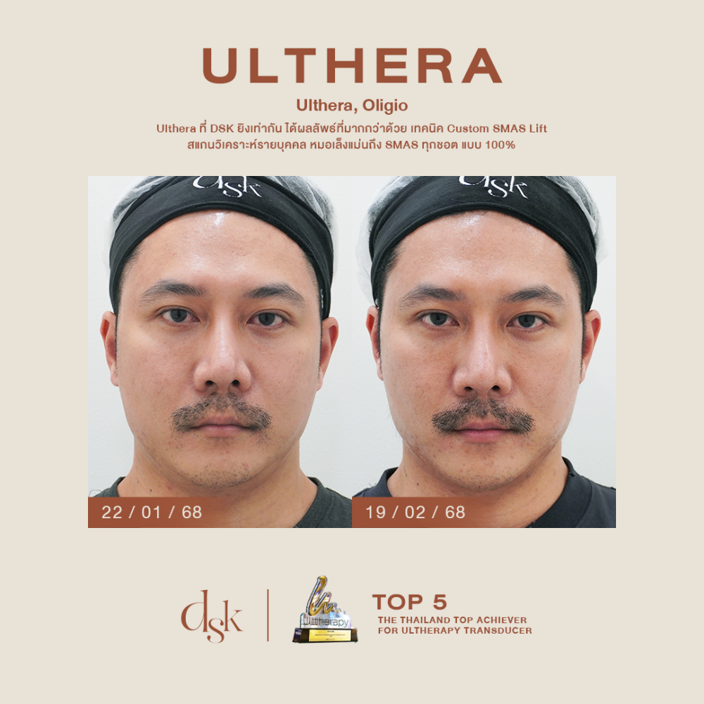 HN.P68-000382_Ulthera, Oligio_dr.prince