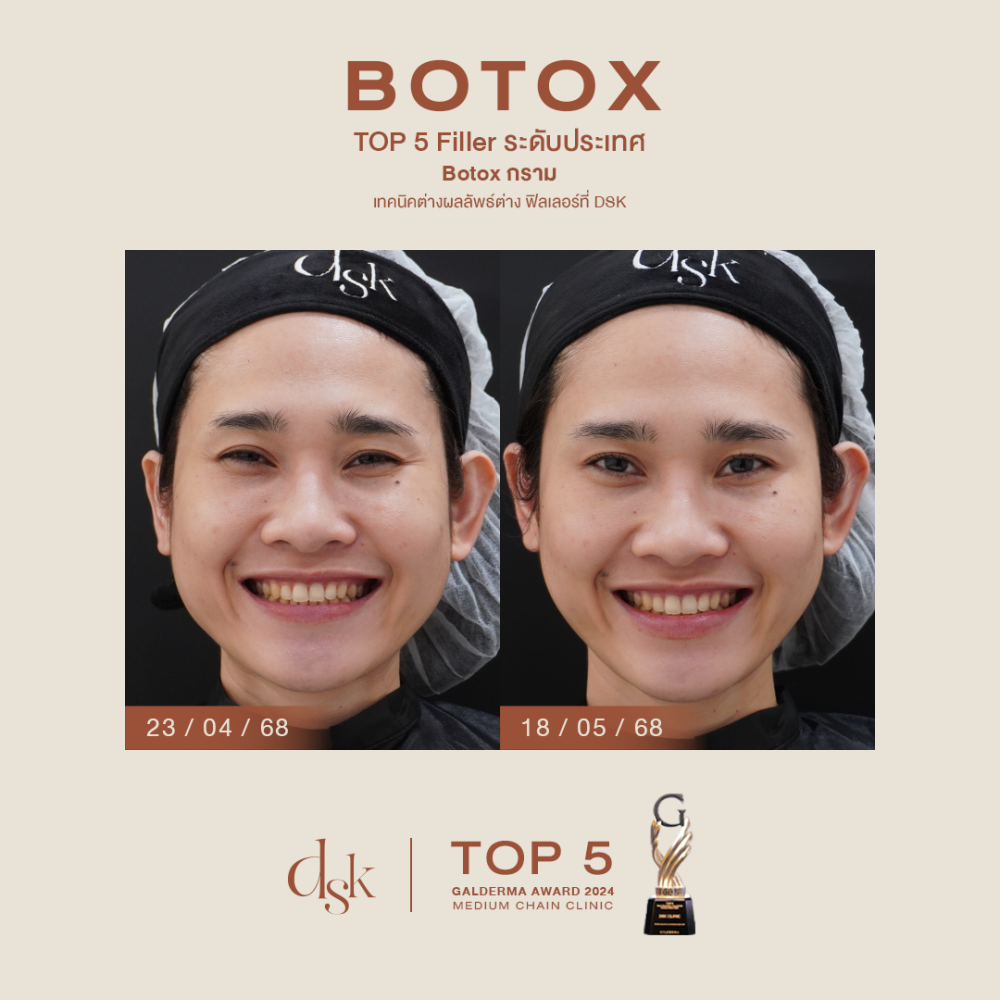 HN.P68-000516_botox กราม