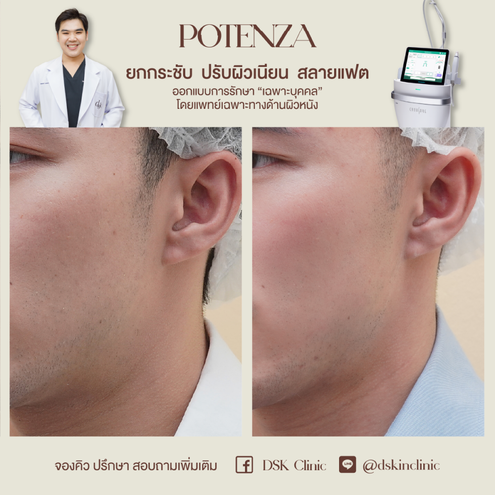 HN.R65-015651_potenza_รูขุมขน1