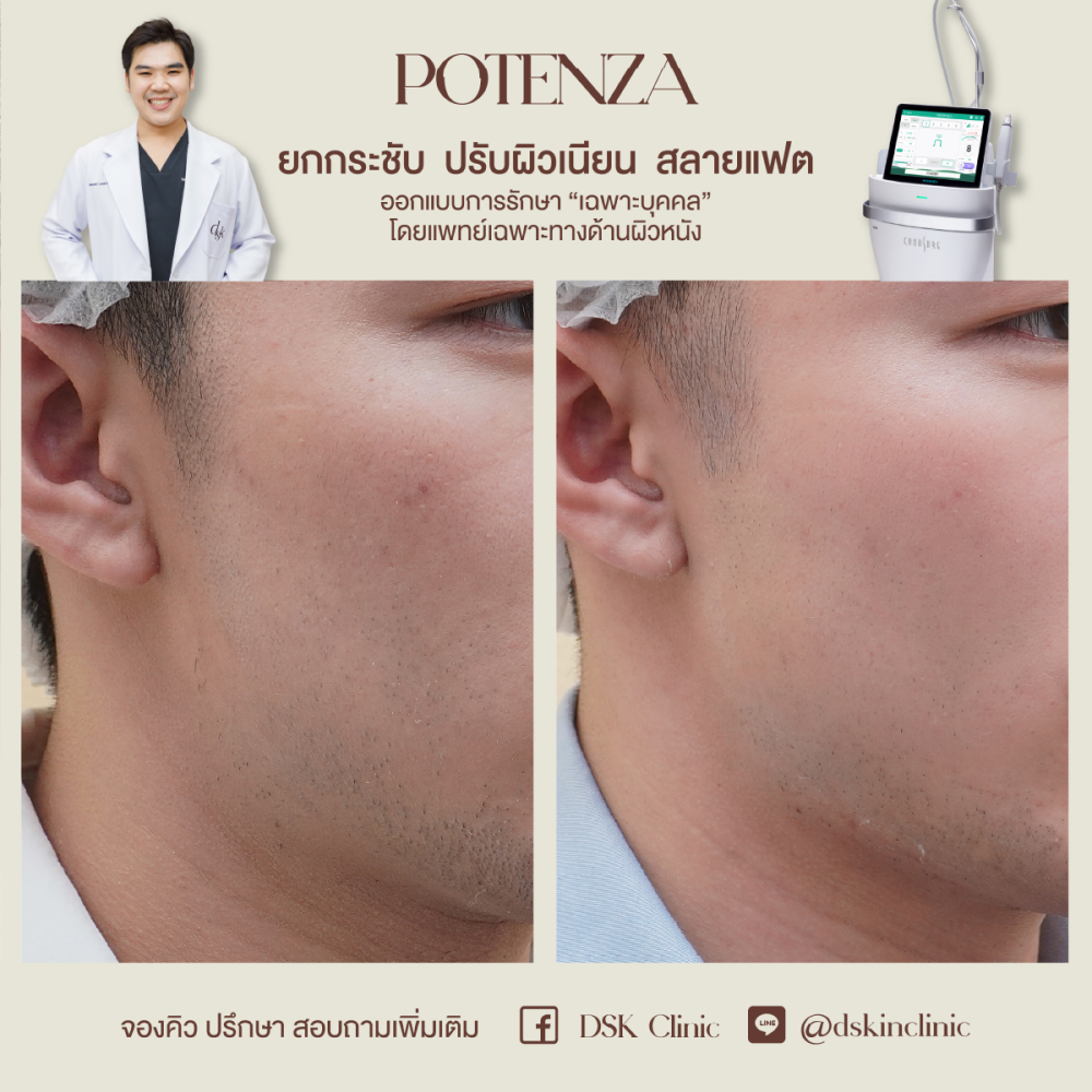 HN.R65-015651_potenza_รูขุมขน2