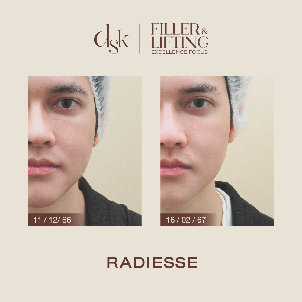 HN.R65-015652_radiesse