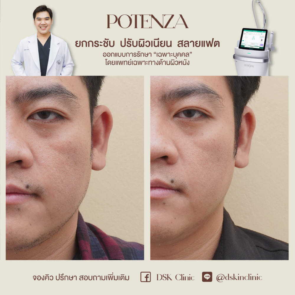 HN.R65-015674_Potenza_ยกกระขับ