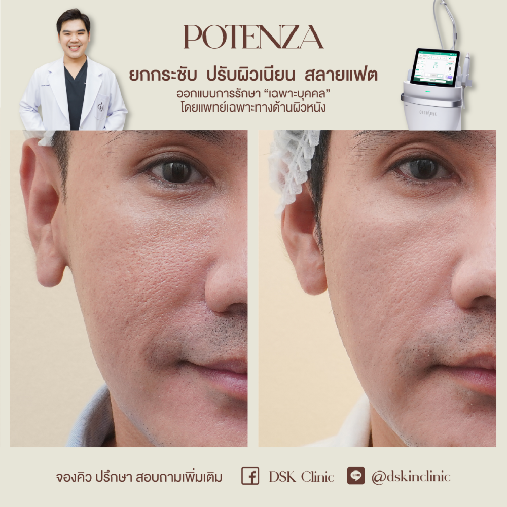 HN.R65-015914_Potenza_รูขุมขน