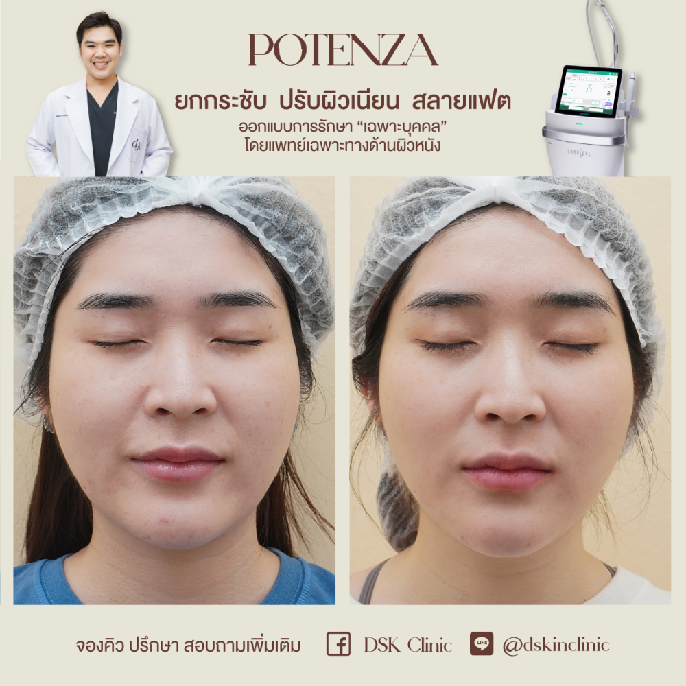 HN.R65-016071_Potenza_ยกกระชับ