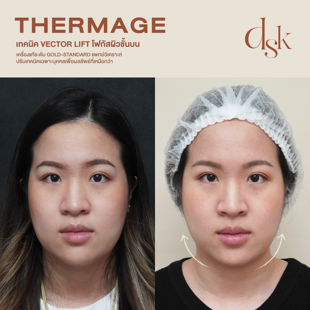 HN.R65-016132_thermage