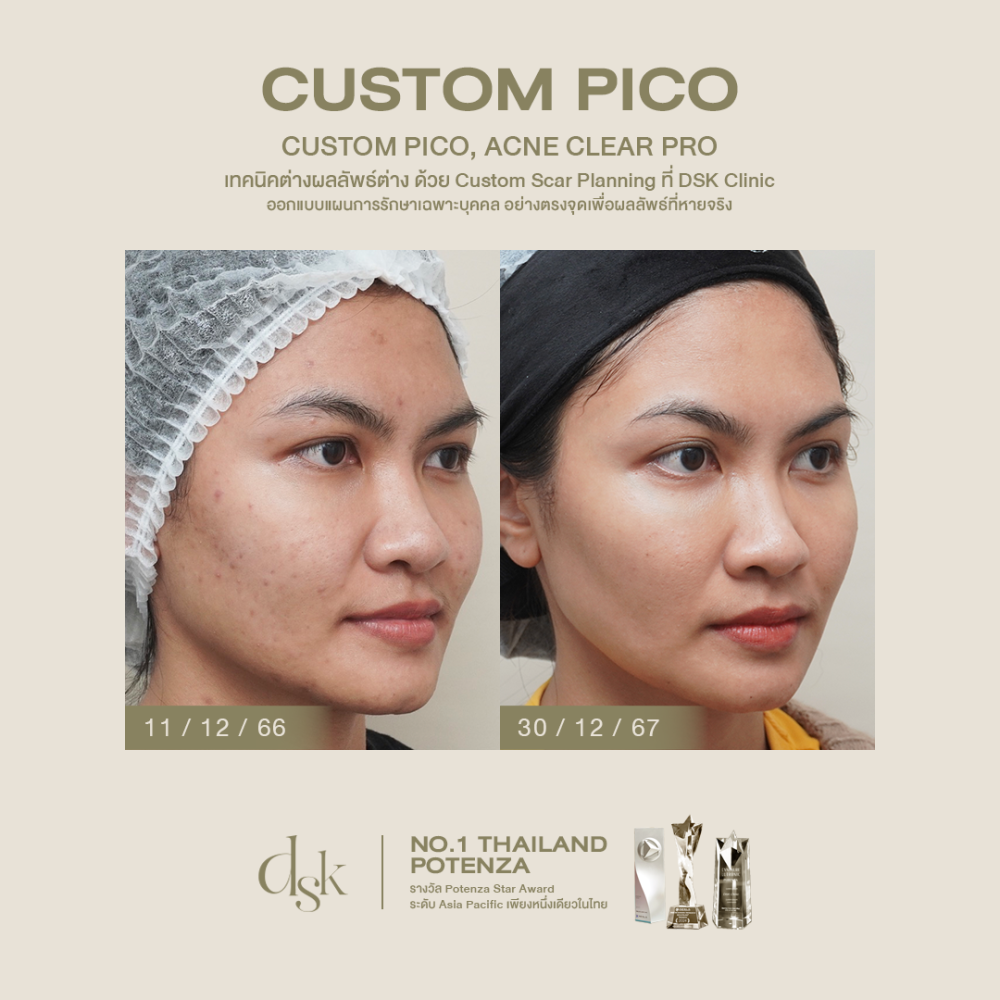 HN.R65-016536_Custom Pico Pro, Acne Clear Pro