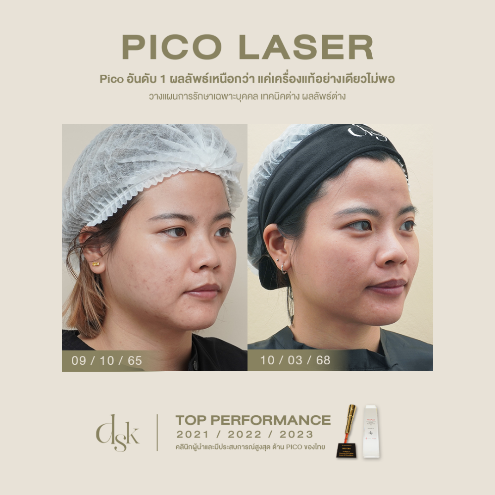 HN.R65-017060_custompico