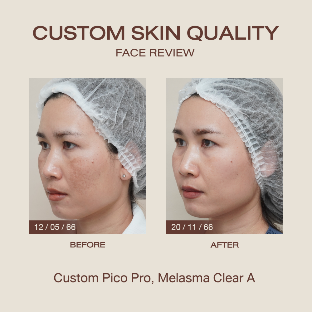HN.R66-017883_pico+melasma