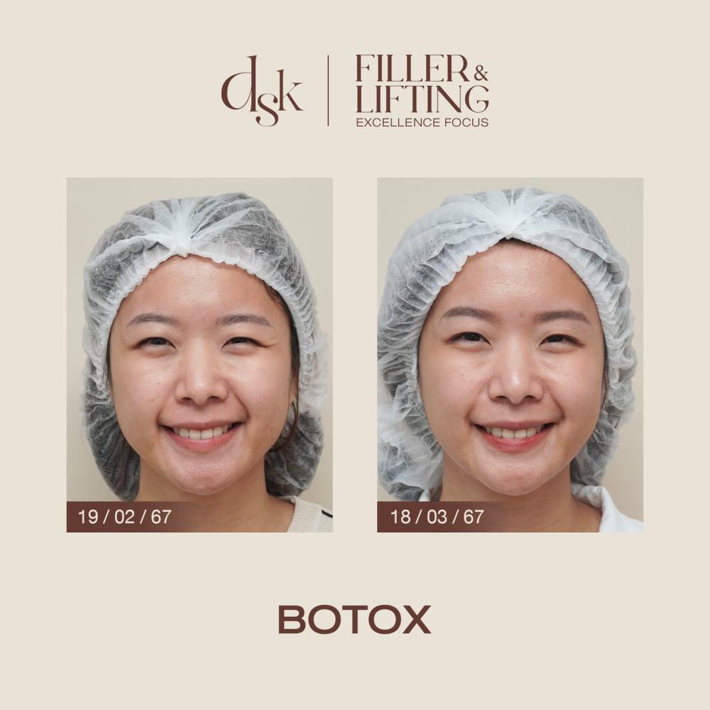 HN.R67-018638_botox_dr.nan_ริ้วรอยตีนกา (1)