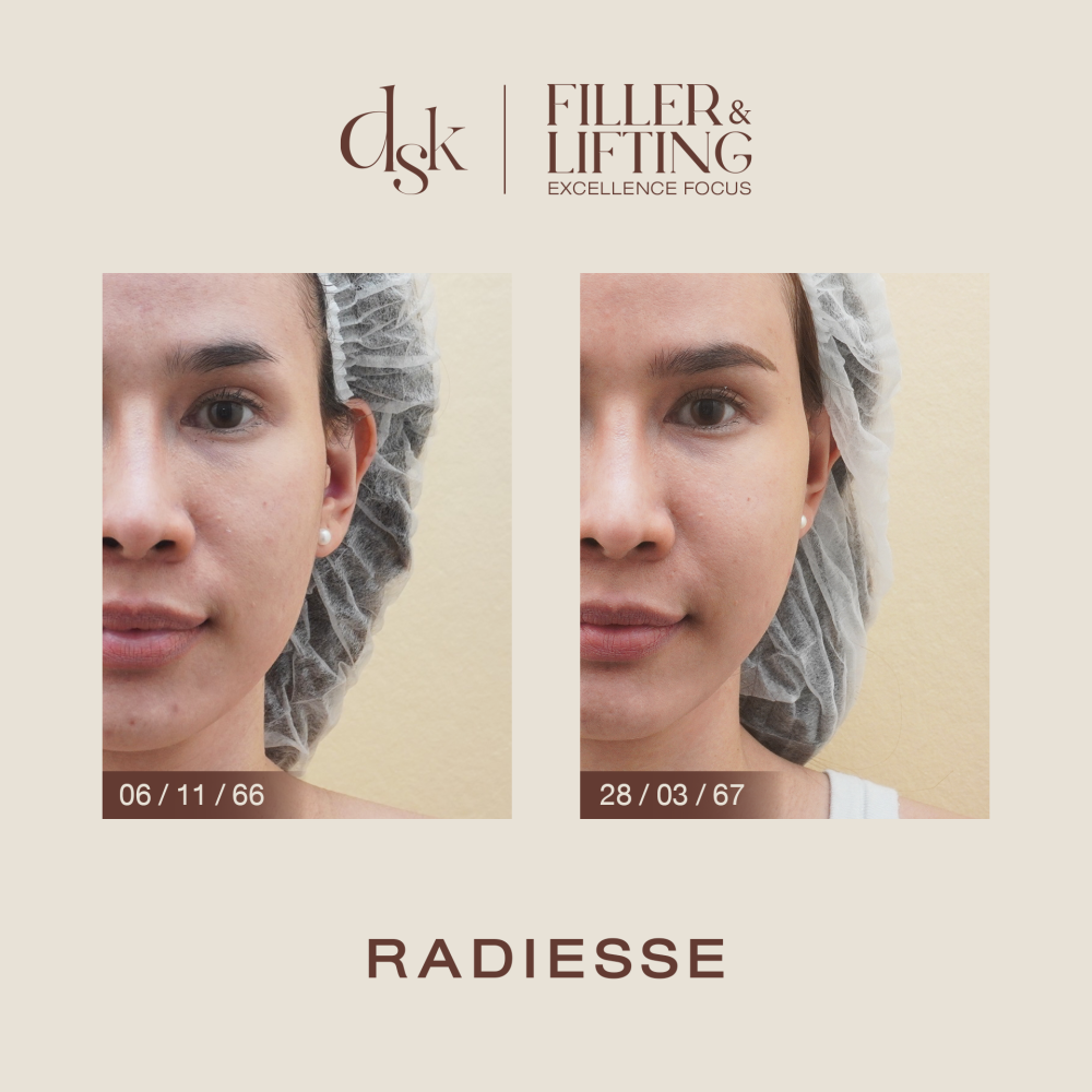 HN.S66-001223_Radiesse